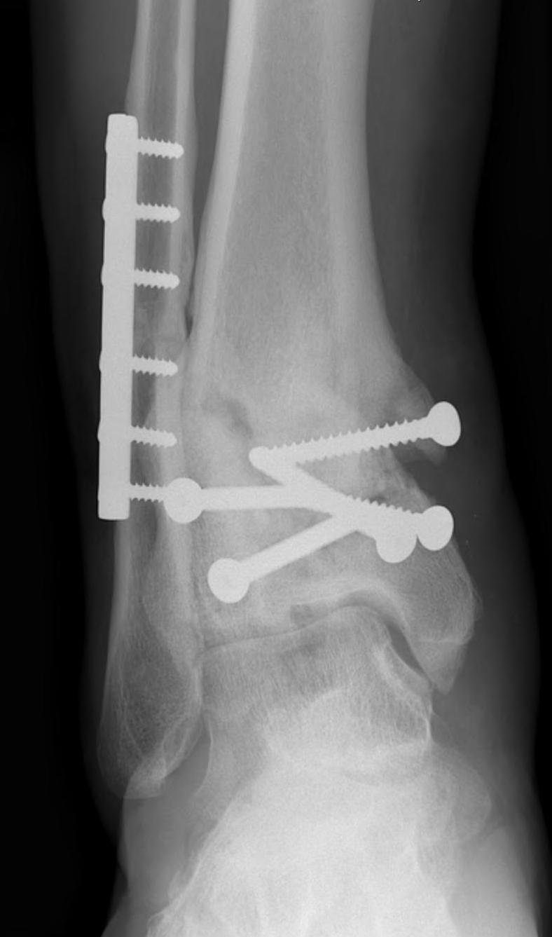 Distal Tibial Malunion AP